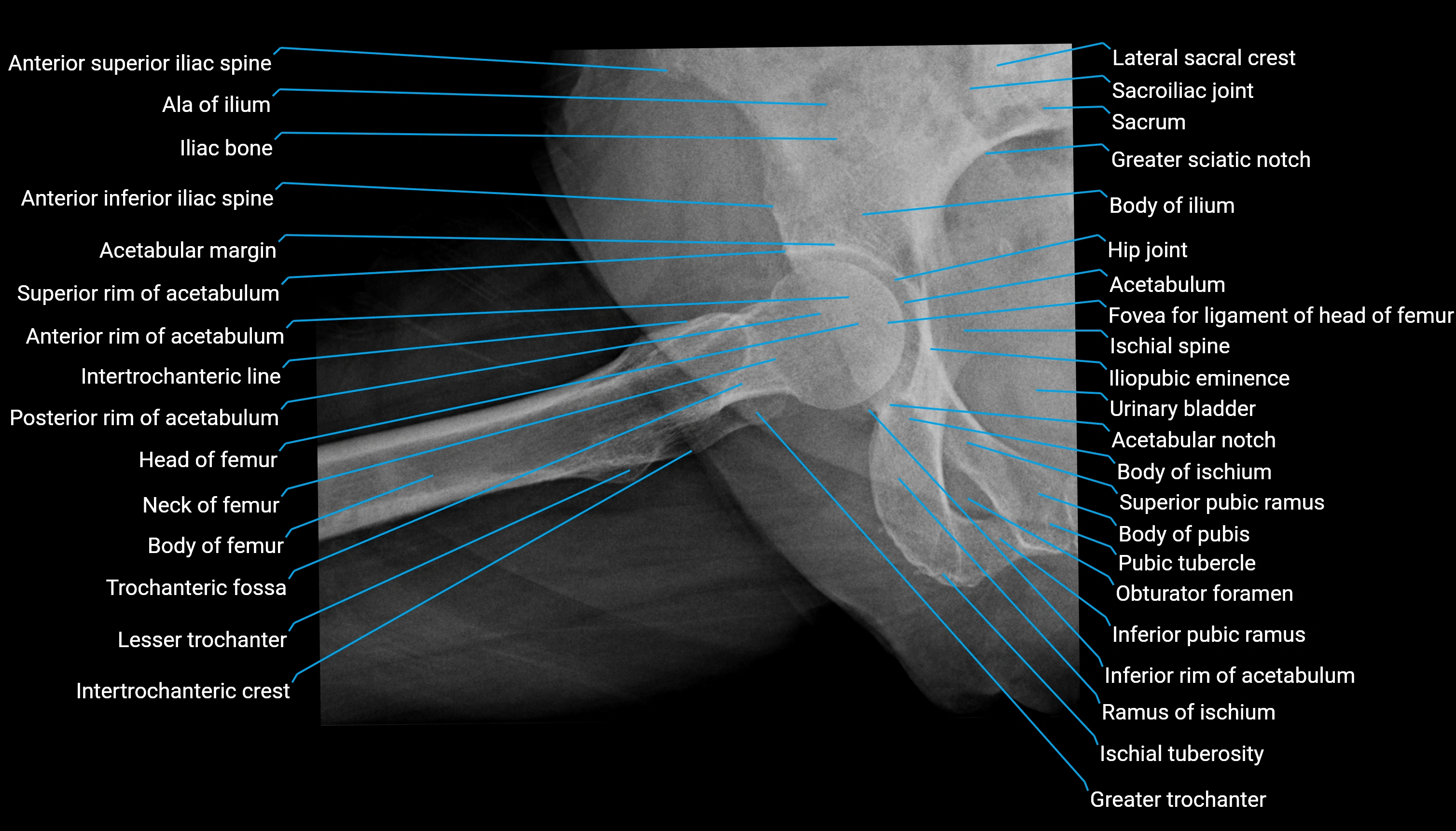 x ray Hip lateral labelled anatomy image.webp